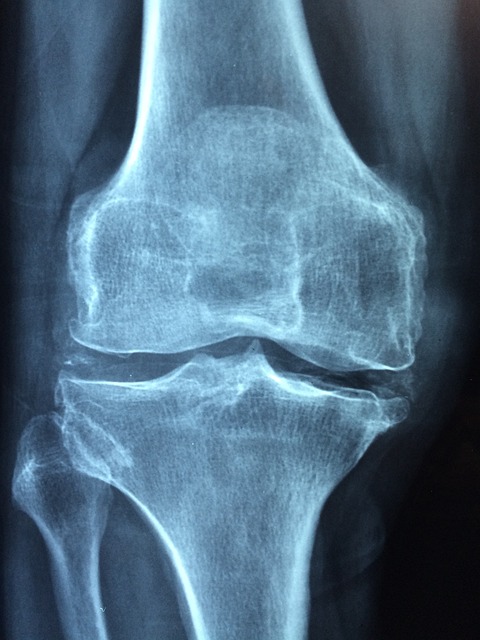 Study Finds Disparities in Patients Having Knee Replacement in ASCs