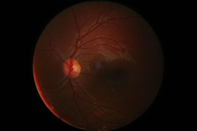 One Retina Detached, the Other Torn on Job, so why no Benefits?